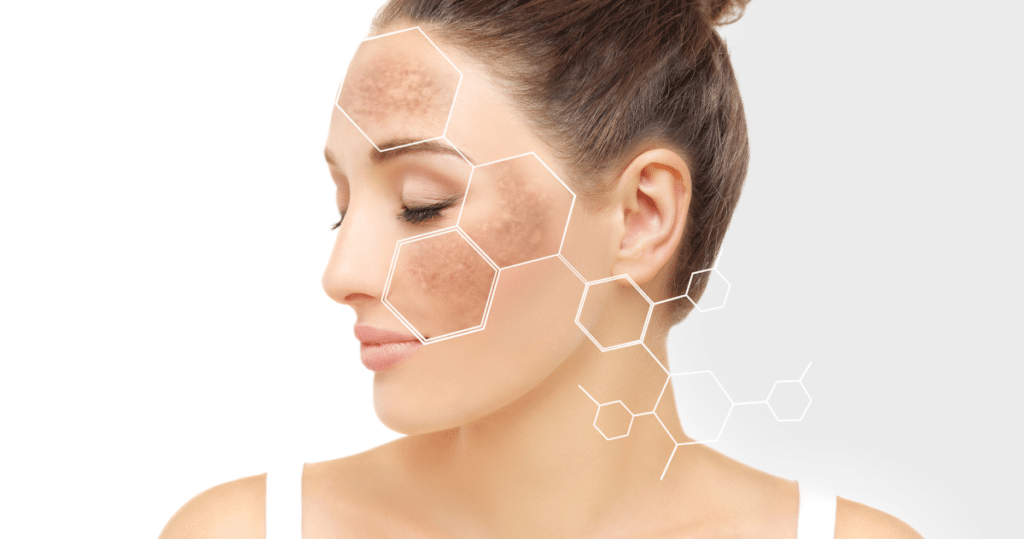 Hyperpigmentation Treatment | Seamless Aesthetics, LLC | North Las Vegas, NV