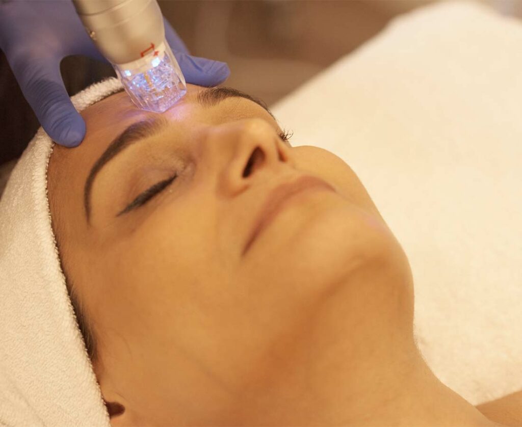 RF Microneedling Treatment | Seamless Aesthetics, LLC | North Las Vegas, NV