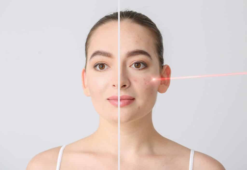 Laser Acne Treatment | Seamless Aesthetics, LLC | North Las Vegas, NV