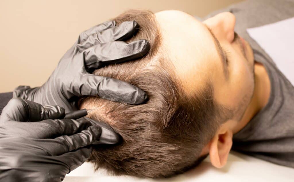 Hair Restoration Treatment | Seamless Aesthetics, LLC | North Las Vegas, NV